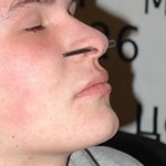Увельчение прокола носовой перегородки