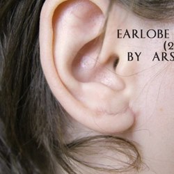 Зашитие ушей поле растяжки мочки уха