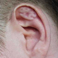 Ear helix subdermal 