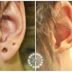 Исправление мочки уха