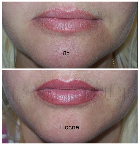 Гранулы фордайса на губах и перманентный макияж фото до и после