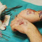 Импланты на руках в виде звездочек