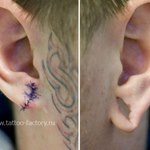 Зашитие дырки в мочке уха