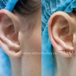 Зашитие мягких тканей уха