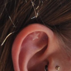 Ear star implant