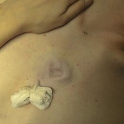 Сердечко на груди (имплант)