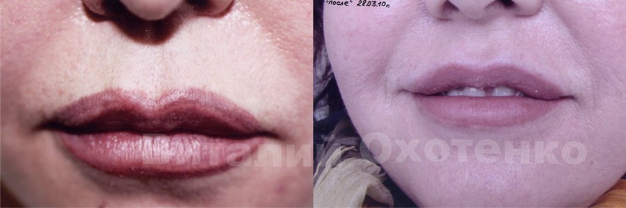 Удаление малых губ до и после фото. Неудачный перманентный макияж губ. Перманентный макияж губ до и после. Неудачный перманент губ.